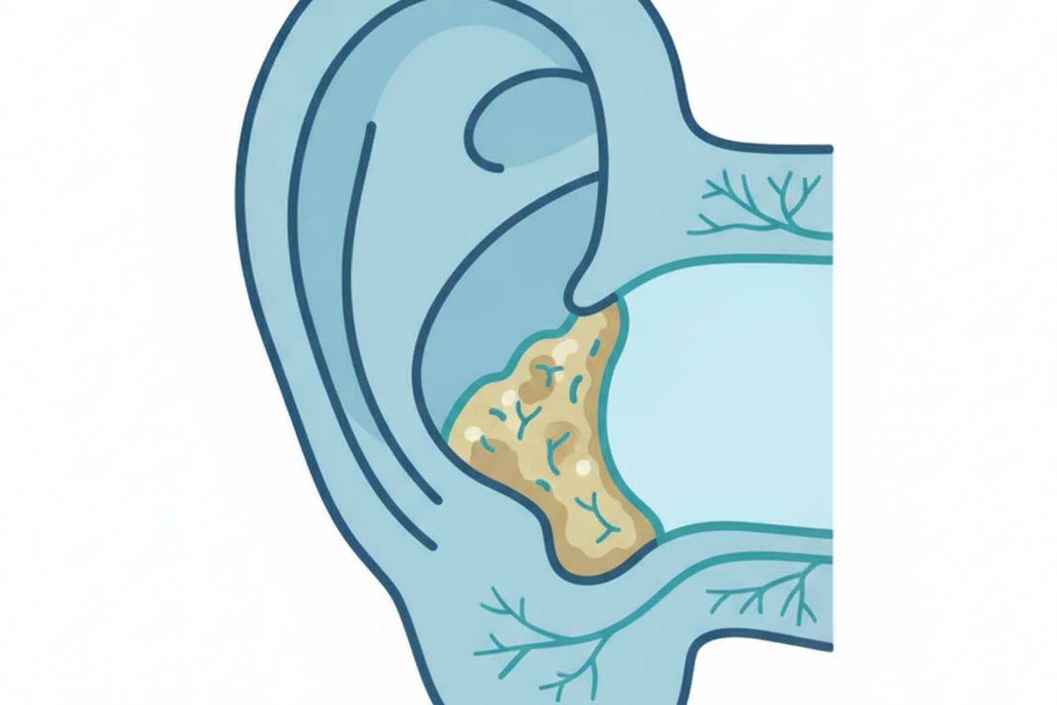 Illustration of ear canal with earwax impaction and safe removal methods