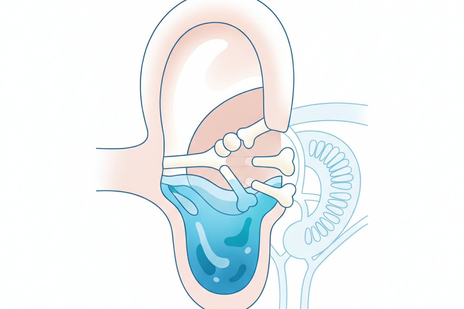 Medical illustration of fluid trapped in the middle ear behind the eardrum