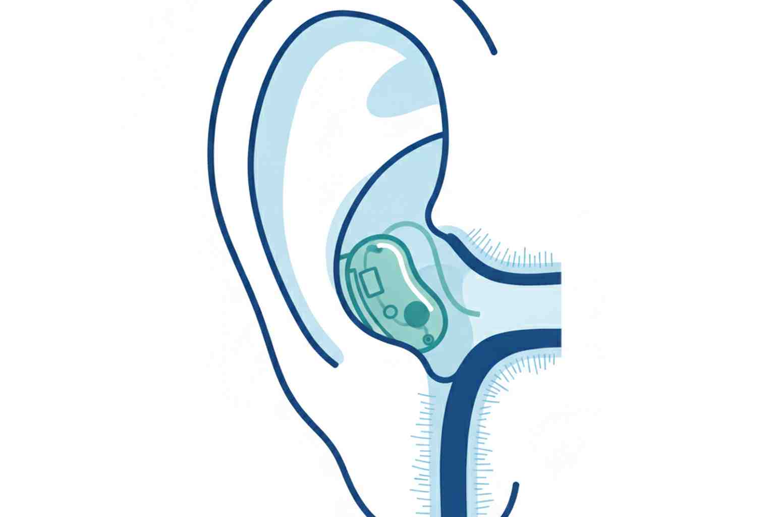 Invisible hearing aid inside ear canal medical illustration