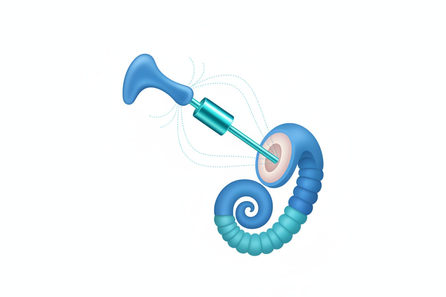 Stapes prosthesis reconnecting the incus to the inner ear