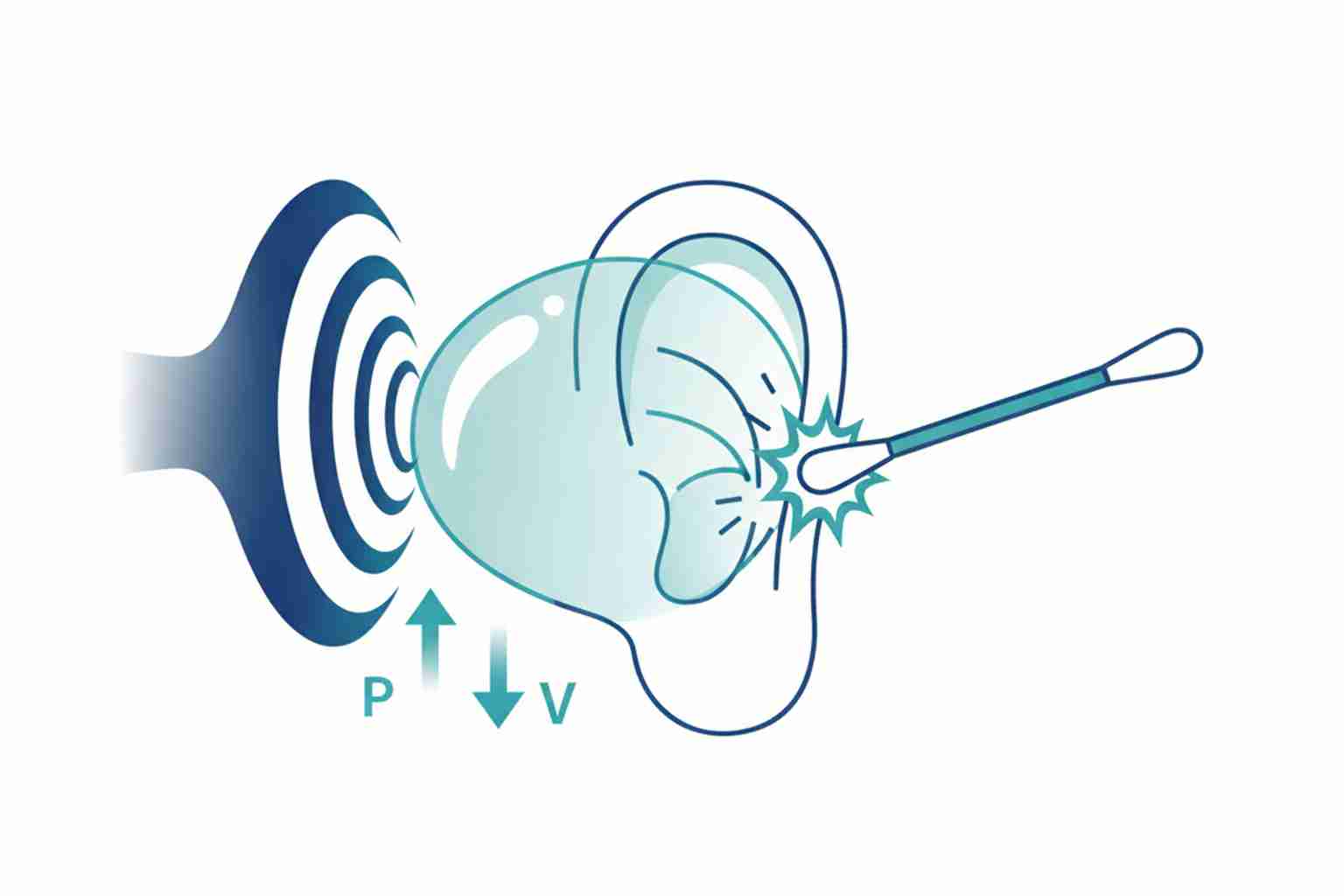 Common causes of a perforated eardrum
