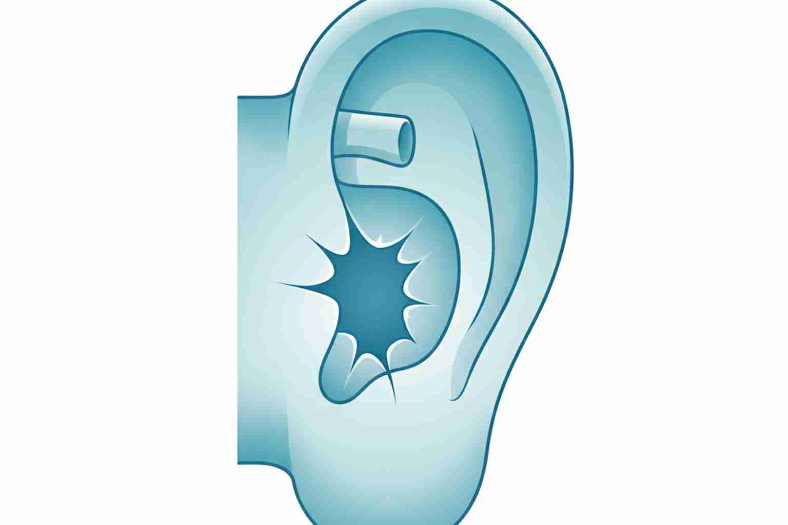 Perforated eardrum symptoms, causes, and treatment from licensed hearing specialists